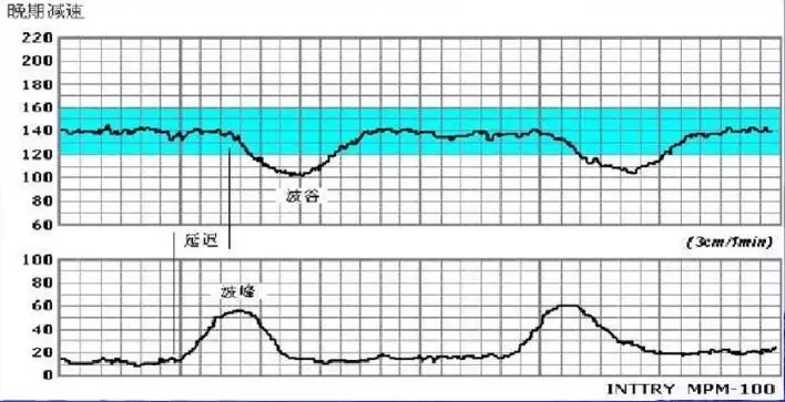 胎心监护胎心减速的三种曲线