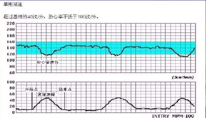 胎心监护胎心减速的三种曲线